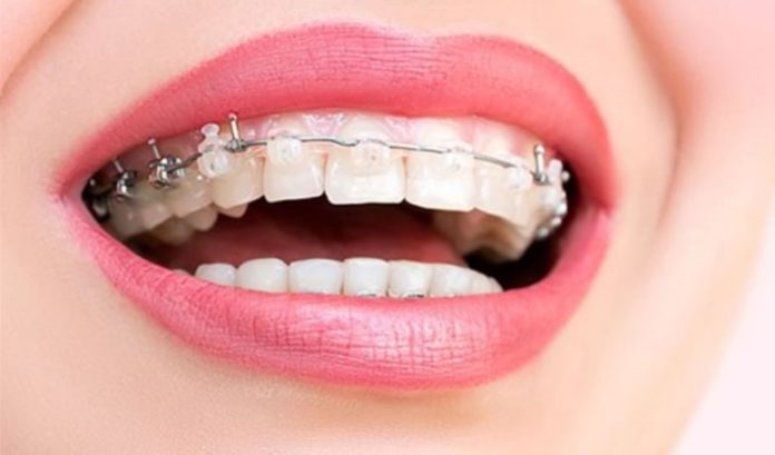 Ağız Sağlığı ve Diş Teli Tedavisi