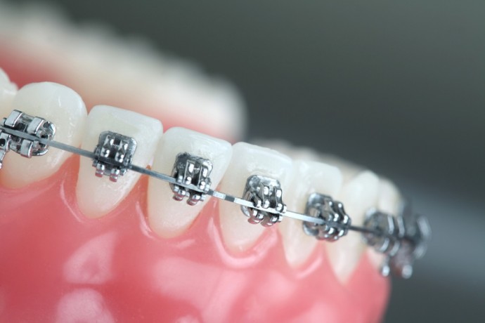 pekistirici ortodonti